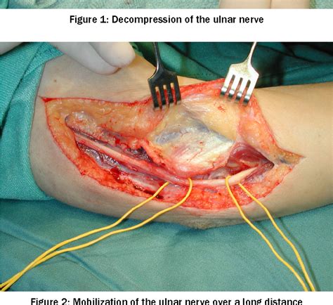 Ulnar Tunnel Syndrome Surgery