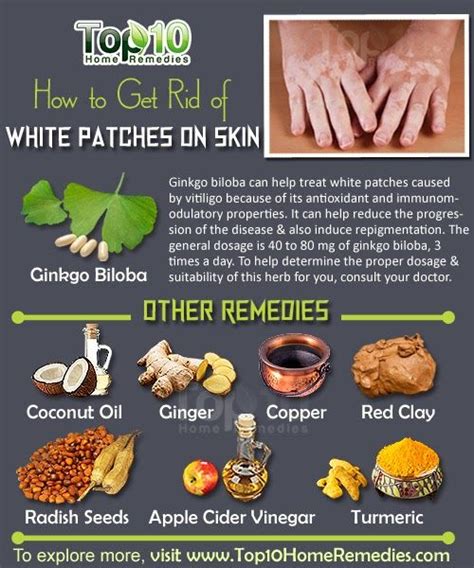 Top ten ways to Get Rid of White Patches on Skin, Vitiligo | Vitiligo ...