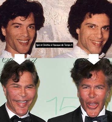 New Celebrity Buzz: Bogdanoff Brothers Before After Plastic Surgery