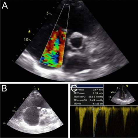 A Transthoracic echocardiogram (TTE) in parasternal short axis view ...