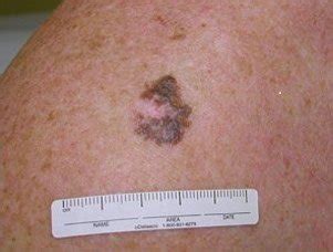 Severely Atypical Mole with Regression: Time to Worry » Scary Symptoms