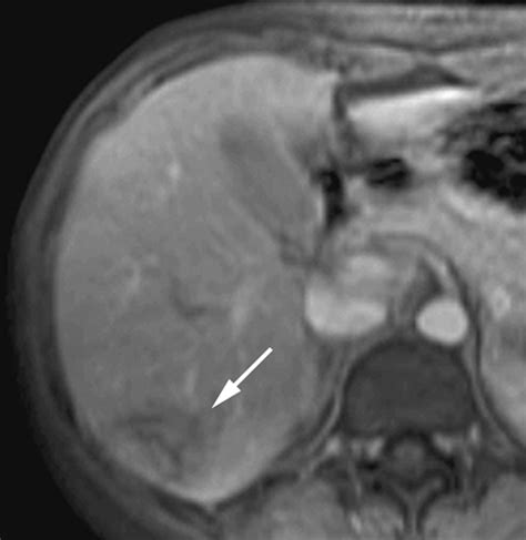 Peliosis Hepatis: Spectrum of Imaging Findings | AJR