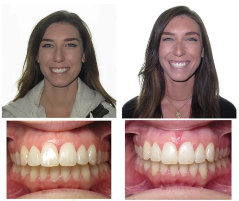 Can Invisalign Actually Fix An Overbite? - Impact Orthodontics