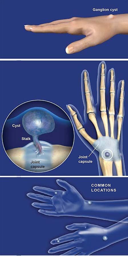 Ganglion Cyst Causes Management Of Painful Ganglion C - vrogue.co