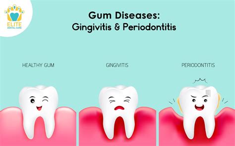 GUM DISEASES: GINGIVITIS & PERIODONTITIS | Elite Dental Care