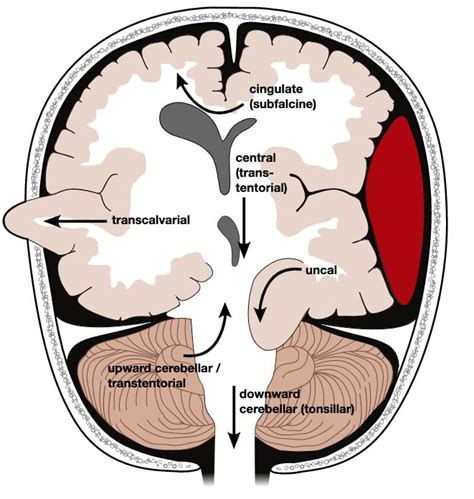 Tonsillar Herniation