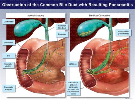 Obstruction of the Common Bile Duct with Resulting Pancreatitis - TrialExhibits Inc.