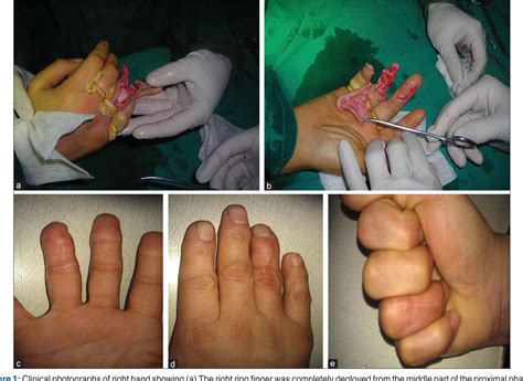 Figure 1 from Replantation of a circumferentially degloved ring finger ...