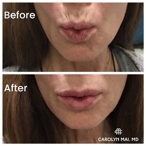 Awasome Best Filler For Lips Lines 2022