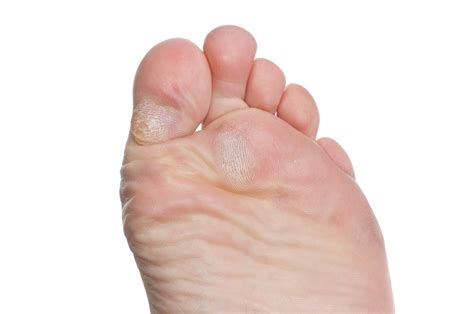 Calluses - Estuary Clinic, Topsham Exeter