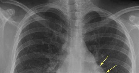 RiT radiology: Left Atrial Enlargement