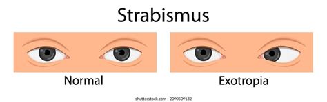 Farsightedness Symptoms Infographics: Over 11 Royalty-Free Licensable Stock Illustrations ...