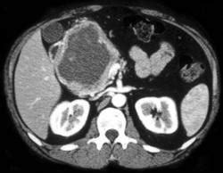 Islet Cell Tumor - Pancreas Case Studies - CTisus CT Scanning