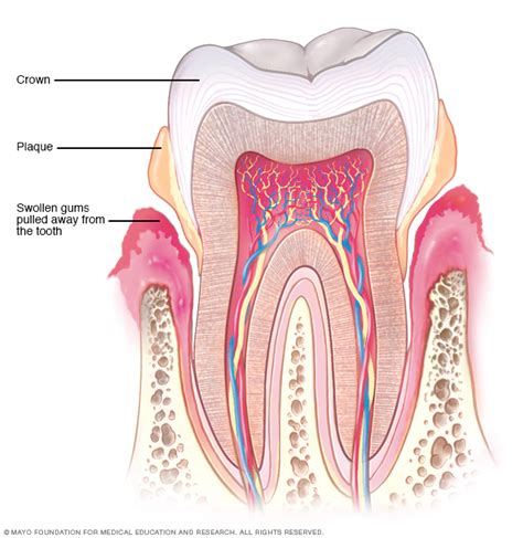 Periodontitis - Symptoms and causes - Mayo Clinic