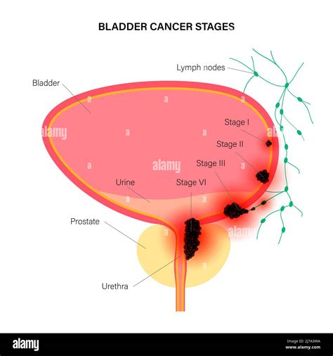 Bladder cancer stages, illustration Stock Photo - Alamy