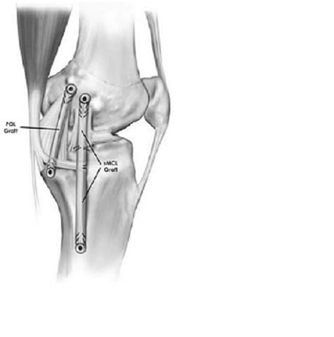 Medial and Lateral Torn Meniscus Repair Surgery (2022)