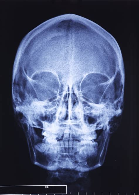 Skull xray stock photo. Image of examination, skeleton - 19001360