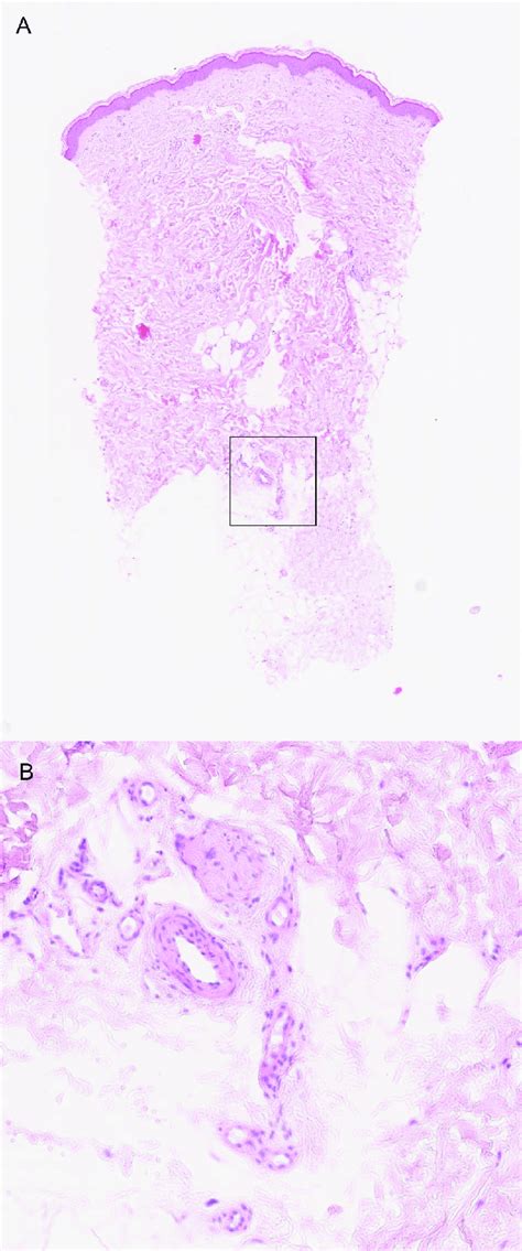 Example one of a probable occlusive microangiopathy. (A) Low ...