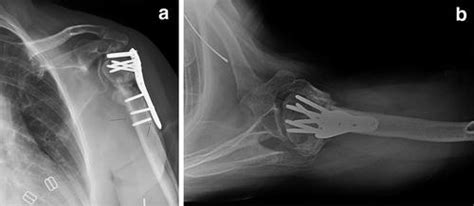 Complications of Treatment of Proximal Humerus Fractures ...