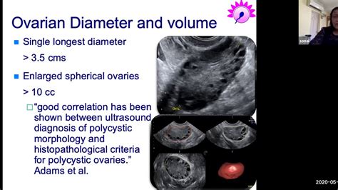 Polycystic Ovaries - Dignosis by USG, Ovulation Induction & Assited Reproduction - YouTube