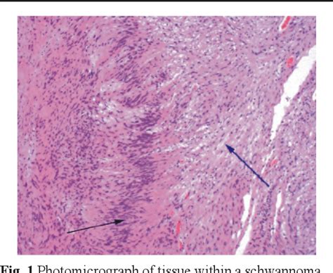 Figure 1 from Approach to Brachial Plexus Tumors-Our Experience ...