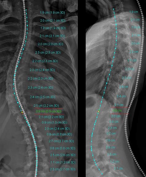 Anteroposterior and lateral view of EOS images with 2D and 3D spine ...