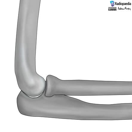 Elbow joint effusion (illustration) | Radiology Case | Radiopaedia.org