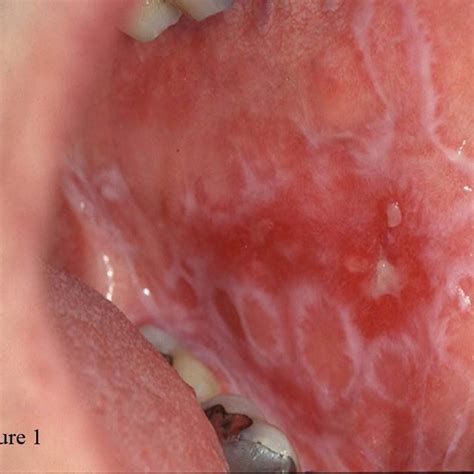 Reticular and erosive oral lichen planus on the buccal mucosa ...