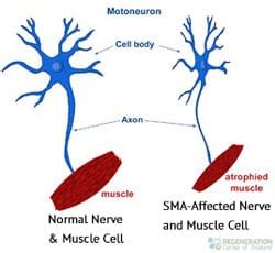 Stem Cell Treatment for SMA - Spinal Muscular Atrophy