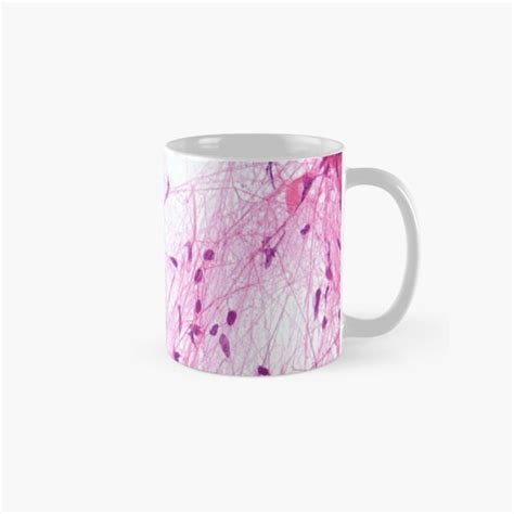 "Astrocytoma Histology" Mug by deltoid | Redbubble