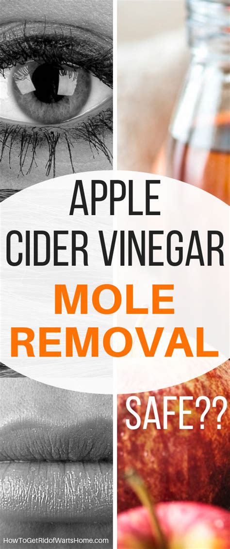 Apple Cider Vinegar Mole Removal Problems - All Are Here