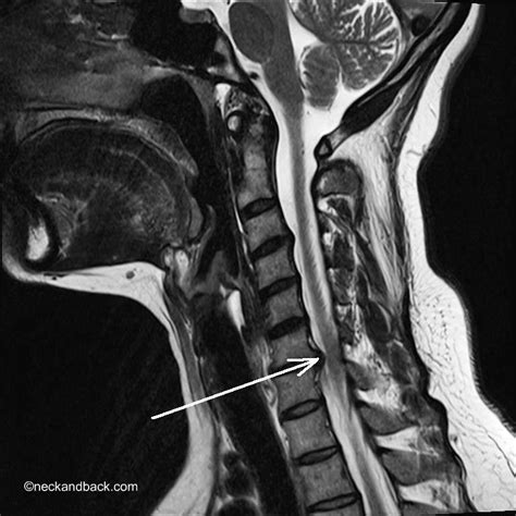 Lateral Cervical MRI of Disc Herniation | Dr Donald Corenman | Colorado ...