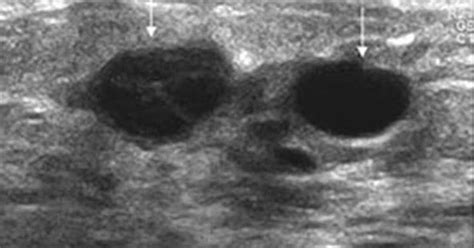 Breast Ultrasound Cancer vs Benign Breast - Cancer OZ