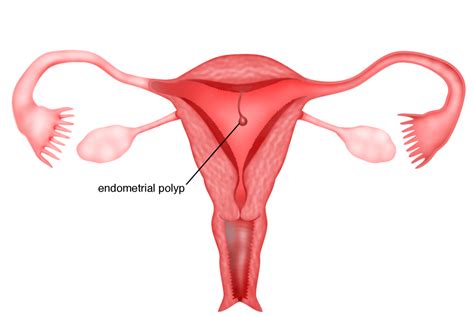 Chapter 6 – Endometrial polyps – Melaka Fertility