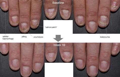 Significant Improvement in Plaque Psoriasis Seen With Cosentyx - MPR