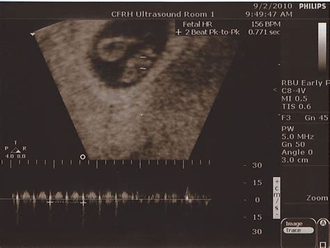 Hey Baby, We're Waiting! Our IVF and Endo Journey: First Ultrasound!!