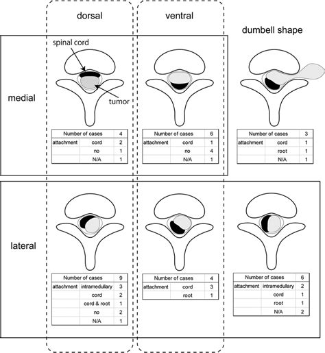 The schema of classification of intradural extramedullary ependymomas... | Download Scientific ...