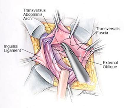 The Shouldice NON-MESH Tissue Repair - Surgical Tour (Panel 4) - Hernia ...