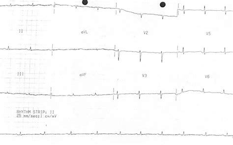 Hypothyroidism ECG changes • LITFL • ECG Library