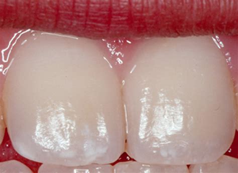 Dental fluorosis causes, prevention, symptoms & dental fluorosis treatment