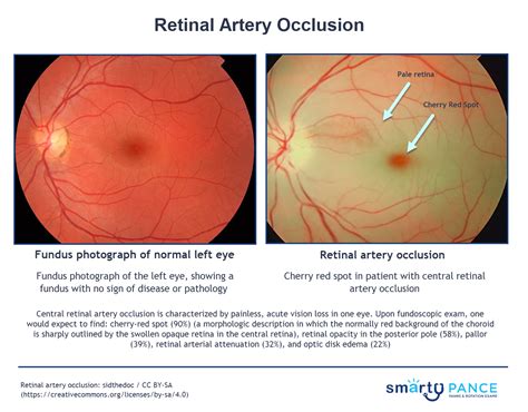 Retinal Artery Occlusion with Pale Retina and Cherry Red Spot in Comparison with FUndus ...