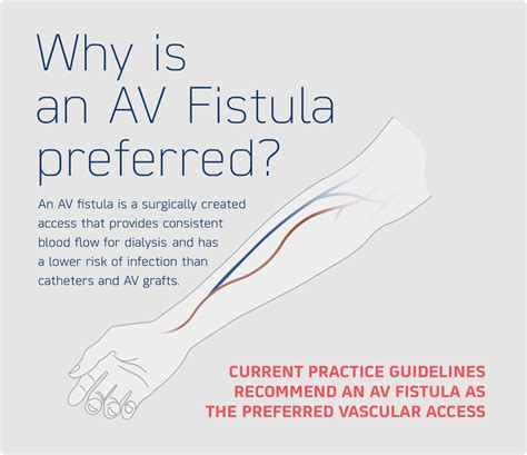 Dialysis Fistula Vs Graft