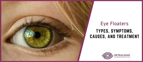 Eye Floaters – Types, Symptoms, Causes, and Treatment