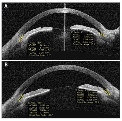 LPI, Iridoplasty, or ECP for Chronic Angle-Closure Glaucoma? - Glaucoma ...