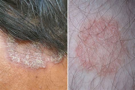 Psoriasis vs. Ringworm: Key Similarities and Differences