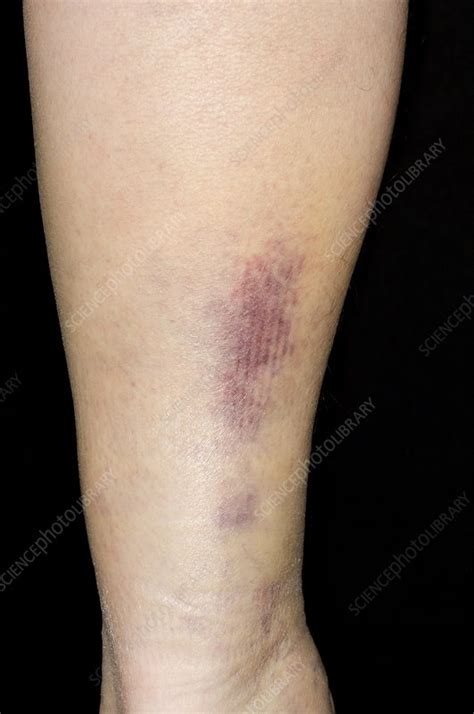 Bruising due to a torn calf muscle - Stock Image - C008/3687 - Science Photo Library