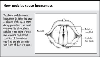 Symptoms and Causes - Vocal Nodules