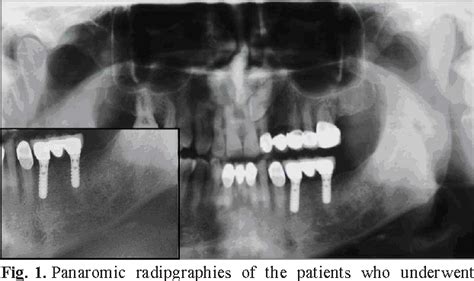 Figure 1 from Is supraperiosteal infiltration anesthesia safe enough to ...