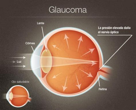 La importancia de la detección precoz en el tratamiento del glaucoma – Salud y Medicina