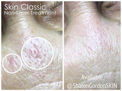 Sebaceous Hyperplasia — Sharon Gordon SKIN